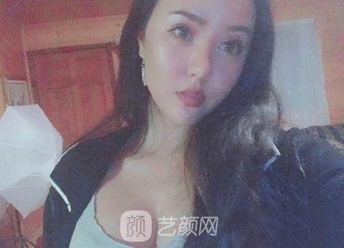 成都置美谢红权医生脂肪隆胸实例公开｜内附体验成果图