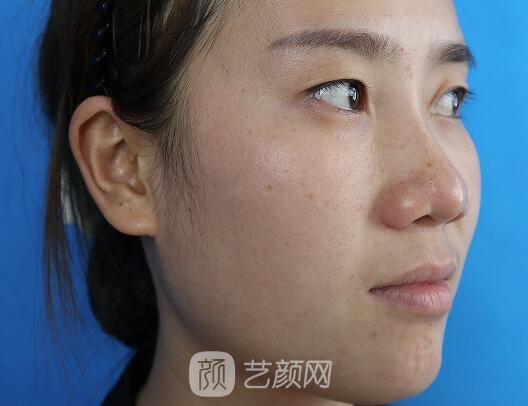 上海灵之水罗飞彪医生做鼻子风格公开｜成果自然无痕
