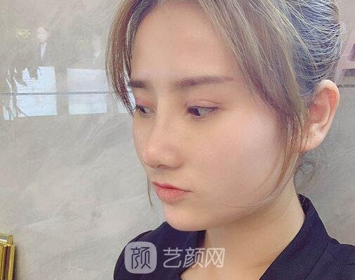 上海灵之水罗飞彪医生做鼻子风格公开｜成果自然无痕