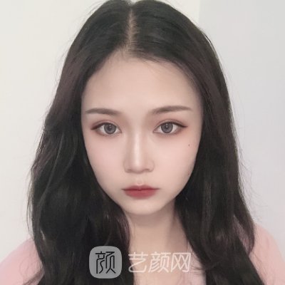 四川娇点医疗美容医院口碑怎么样?全新双眼皮整形实例一览