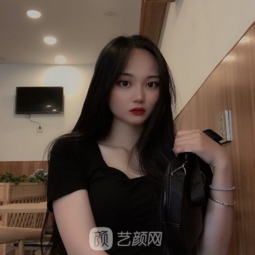 南方医院胡志奇医生头发加密技术怎么样?亲身体验实例公开
