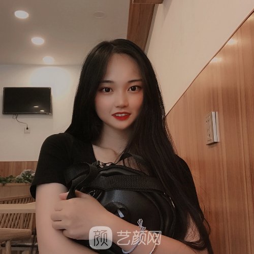 南方医院胡志奇医生头发加密技术怎么样?亲身体验实例公开