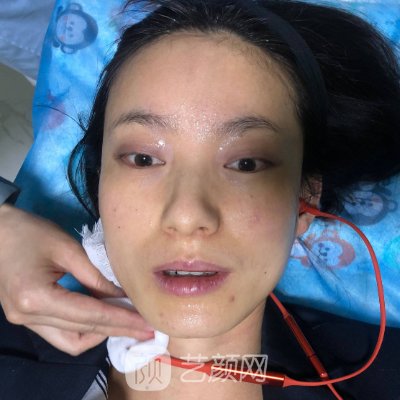 绍兴上虞艺美整形医院玻尿酸除皱实例公开｜内附对比图