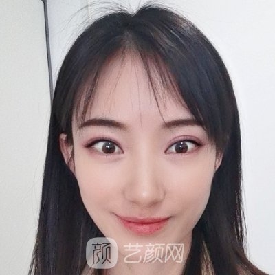 绍兴上虞艺美整形医院玻尿酸除皱实例公开｜内附对比图
