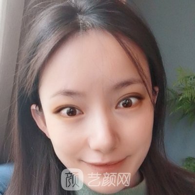 绍兴上虞艺美整形医院玻尿酸除皱实例公开｜内附对比图
