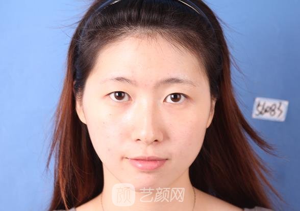 上海陈翌农双眼皮风格展示｜内附全新体验实例