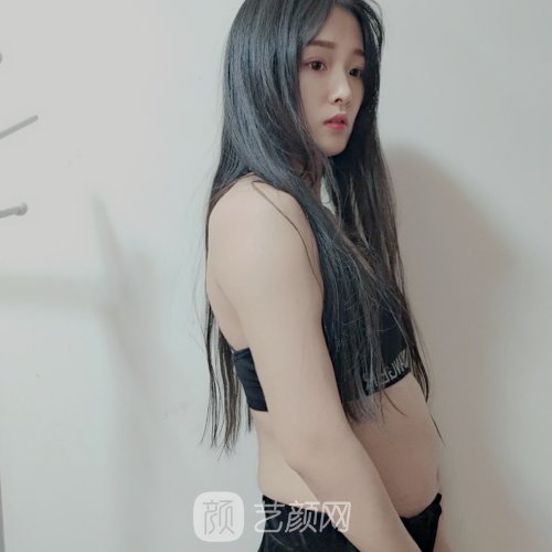 长沙爱思特医疗美容医院正规吗?全新腰腹吸脂实例一览