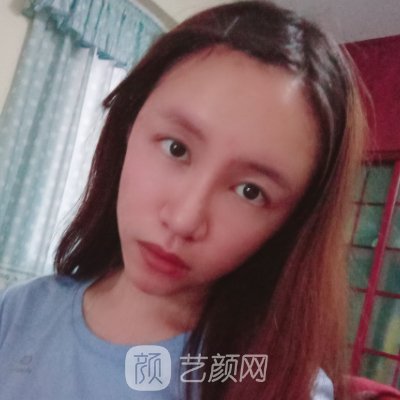 北京华臣谭章梅医生技术怎么样?2023面部脂肪填充实例公开