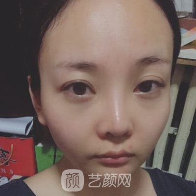 无锡恩喜医疗美容医院怎么样?全新除皱抗衰实例公开