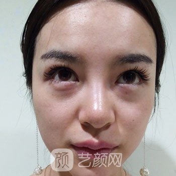 常冬青医生做的眼袋怎样呢？医生简介+去眼袋实例图片