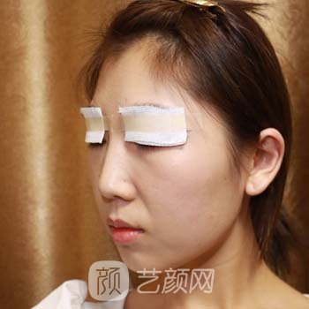 惠州中心医院孟宏双眼皮手术实例分享，技术不错，实力强