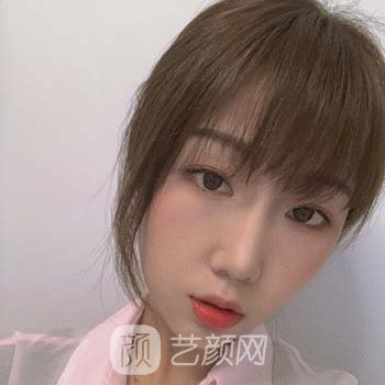 惠州中心医院孟宏双眼皮手术实例分享，技术不错，实力强