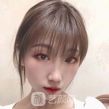 惠州中心医院孟宏双眼皮手术实例分享，技术不错，实力强