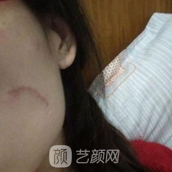 武晓莉修复费用是多少？医生详细介绍+实例对比图