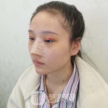 洛阳东方医院双眼皮实例，眼睛漂亮不少，这种感觉真好