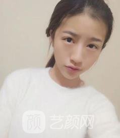 中山市人民医院割双眼皮怎么样？价格多少钱？医生介绍+实例