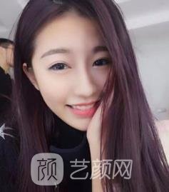 中山市人民医院割双眼皮怎么样？价格多少钱？医生介绍+实例