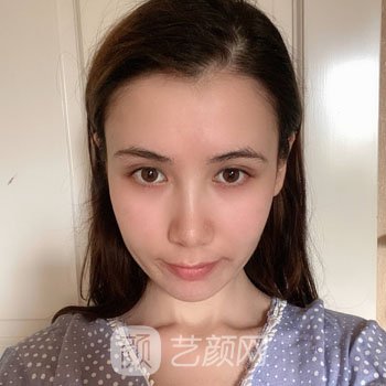 人造酒窝失败修复实例图片，真人修复全过程鉴赏