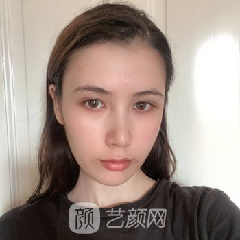 人造酒窝失败修复实例图片，真人修复全过程鉴赏