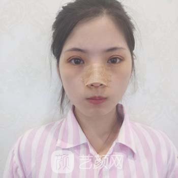 杜园园双眼皮修复实例，医生个人简介收费价格表