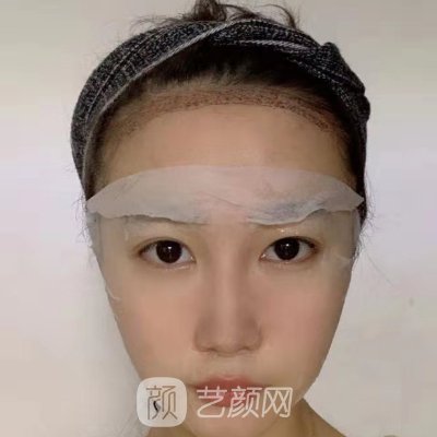 扬州大麦植发医院发际线种植实例公开|附体验对比图