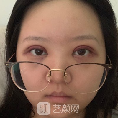 长沙湘雅附二医院整形外科怎么样？全新双眼皮实例一览