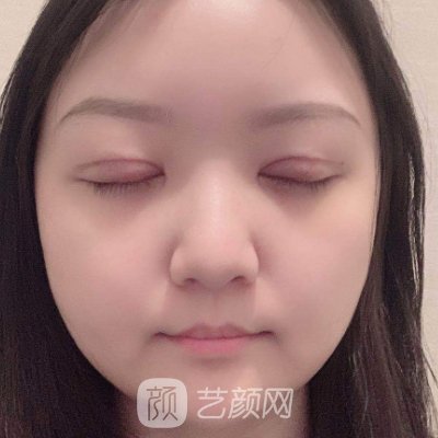 长沙湘雅附二医院整形外科怎么样？全新双眼皮实例一览