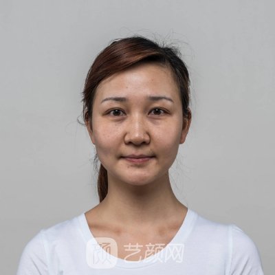 上海市玫瑰医疗美容医院电波拉皮实例分享｜成果自然美观