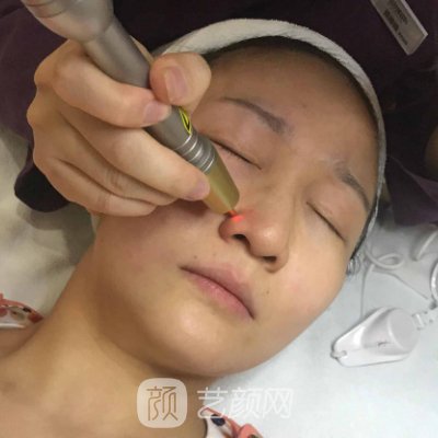 上海市玫瑰医疗美容医院电波拉皮实例分享｜成果自然美观