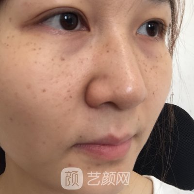 上海市玫瑰医疗美容医院电波拉皮实例分享｜成果自然美观