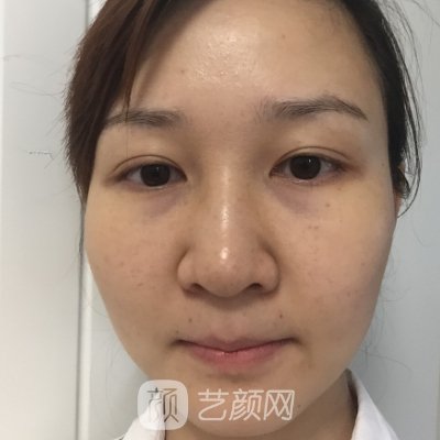 上海市玫瑰医疗美容医院电波拉皮实例分享｜成果自然美观