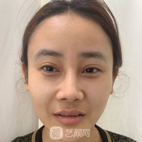 杭州杨海波鼻修复实例出炉|成果自然无痕