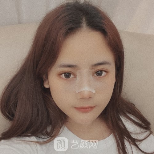 杭州杨海波鼻修复实例出炉|成果自然无痕