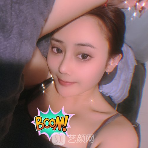 杭州杨海波鼻修复实例出炉|成果自然无痕