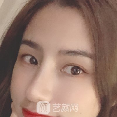 丽水市人民医院整形科正规吗?2023版鼻部实例曝光