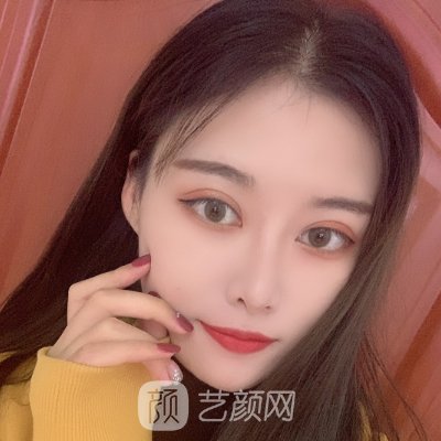 郑州沐恩整形医院招牌双眼皮实例展示|成果自然美观
