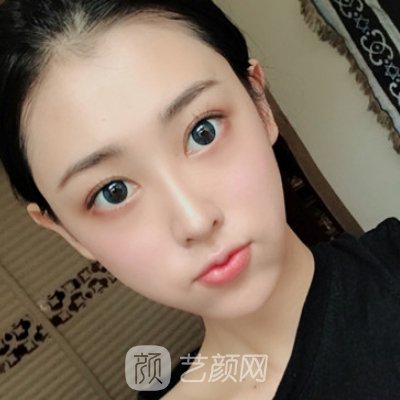 新疆整形美容医院隆鼻实例曝光丨2023招牌实例公开