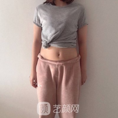 沈阳百嘉丽整形医院腰腹吸脂实例曝光｜成果自然美观