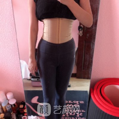 沈阳百嘉丽整形医院腰腹吸脂实例曝光｜成果自然美观