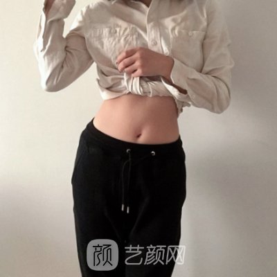 沈阳百嘉丽整形医院腰腹吸脂实例曝光｜成果自然美观