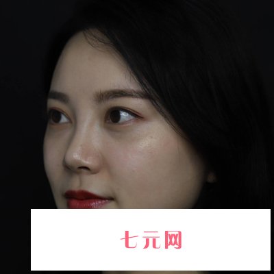 北京正美郑永生隆鼻实例公开|附体验对比图