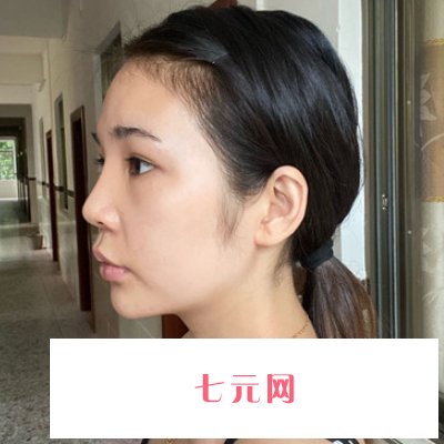 北京禾美嘉任学会面部脂肪填充实例发布｜内附体验对比图