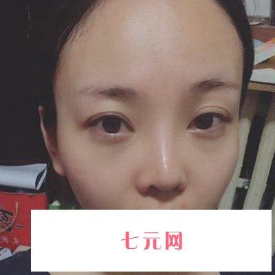 南宁亚韩整形医院注射除皱实例展示|内附体验感悟