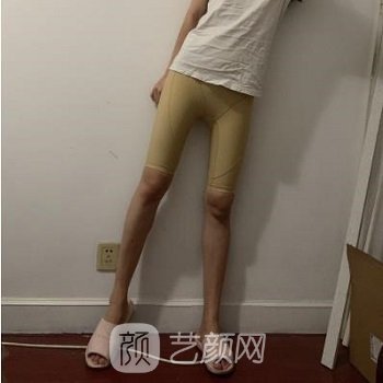 管连斌大腿吸脂实例，纤细美腿，轻松拥有