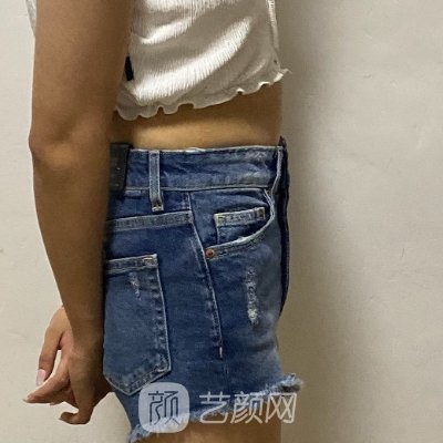 北京蒂凡妮靳玉彪医生吸脂实例出炉|亲身体验细节图一览