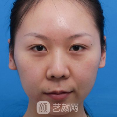 南京郭芳芳医生割双眼皮怎么样?医生实力及实例一览