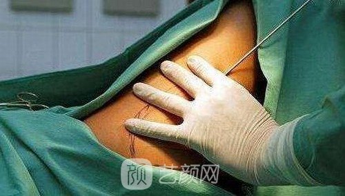 清远韩美医疗美容医院抽脂多少钱？技术怎么样？价格表