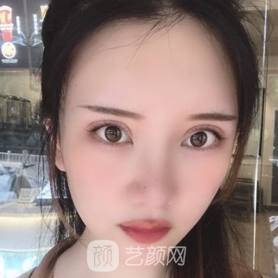 徐州三院做双眼皮怎么样?医院招牌实例分享