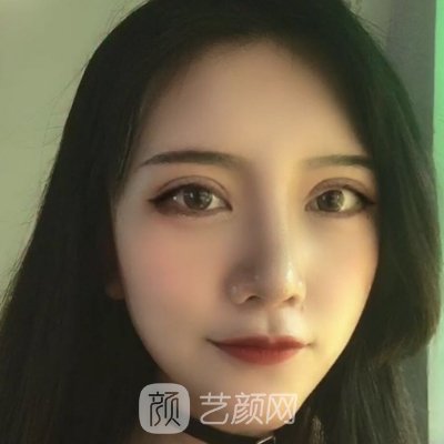 徐州三院做双眼皮怎么样?医院招牌实例分享
