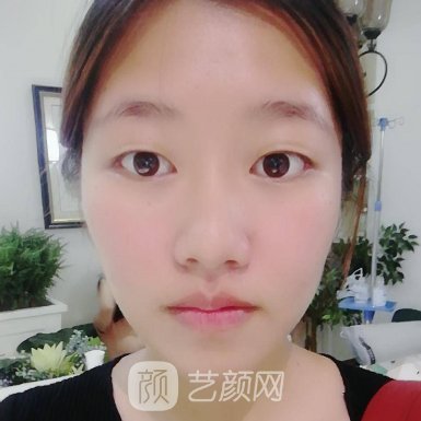 郑州周蔚做双眼皮怎么样?全新体验实例一览